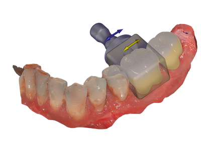 exocad - InCAD Nesting  Add-on Module exocad by exocad- Unique Dental Supply Inc.