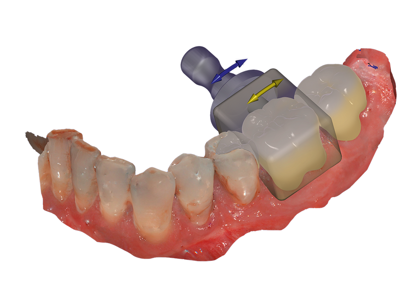 exocad - InCAD Nesting  Add-on Module exocad by exocad- Unique Dental Supply Inc.