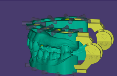 exocad - xSNAP Module DentalCAD Add-on Module exocad by exocad- Unique Dental Supply Inc.