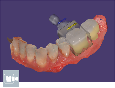 exocad - InCAD Nesting  Add-on Module exocad by exocad- Unique Dental Supply Inc.