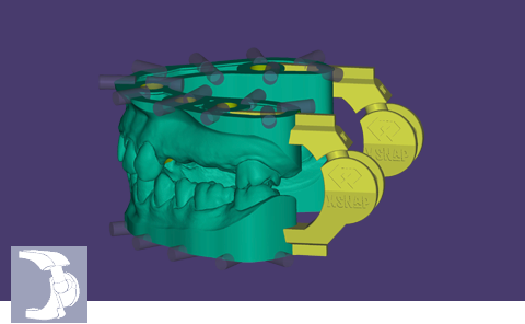 exocad - xSNAP Module DentalCAD Add-on Module exocad by exocad- Unique Dental Supply Inc.