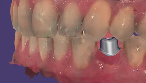 exocad - Chairside CAD Implant Module exocad by exocad- Unique Dental Supply Inc.