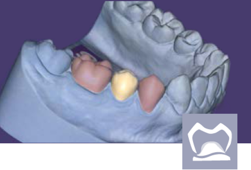 exocad -Provisional Add On Module exocad by exocad- Unique Dental Supply Inc.