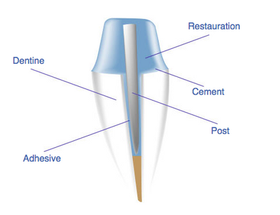 Conical 4-6% Anatomical Posts - Fiber Posts Fiber Posts by BioLoren- Unique Dental Supply Inc.